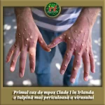 Primul caz de mpox Clade I în Irlanda – o tulpină mai periculoasă a virusului detectată la o persoană întoarsă din Africa