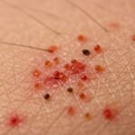 HIQA: Răspuns „fragmentat și lipsit de coordonare” la un focar de râie într-un azil din Kilkenny Focar râie azil Kilkenny - imagine reprezentativă pentru raportul HIQA