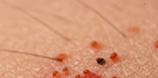 HIQA: Răspuns „fragmentat și lipsit de coordonare” la un focar de râie într-un azil din Kilkenny Focar râie azil Kilkenny - imagine reprezentativă pentru raportul HIQA